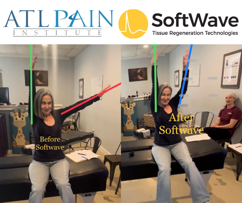 Thawing the Freeze: SoftWave Therapy's Breakthrough in Frozen Shoulder Treatment at ATL Pain Institute